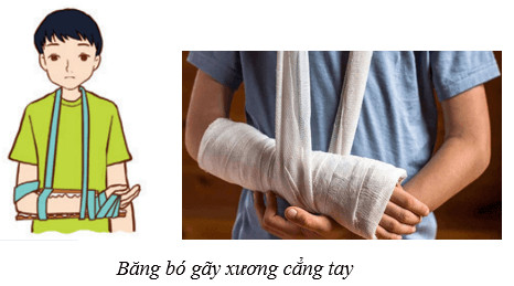 Sơ cứu gãy xương cẳng tay