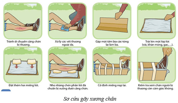 Sơ cứu gãy xương chân