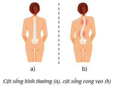 Tật cong vẹo cột sống