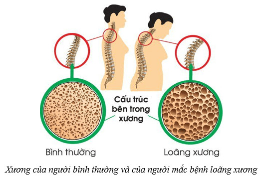 Nguy cơ gãy xương ở người loãng xương
